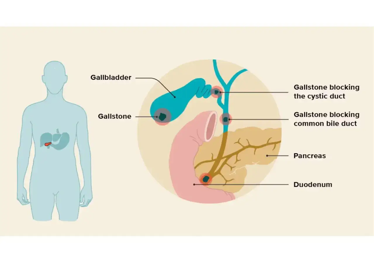 Diagramma illustra calcoli biliari che bloccano dotti, evidenziando la possibilit&agrave; di vivere senza cistifellea.