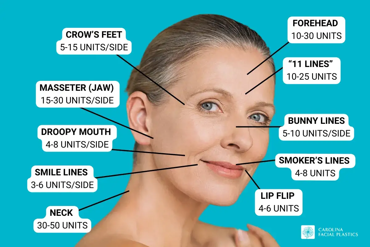 En kvinna visar var botox kan injiceras för att minska rynkor. Informationen ger en uppfattning om botox hur ofta och hur mycket som behövs.