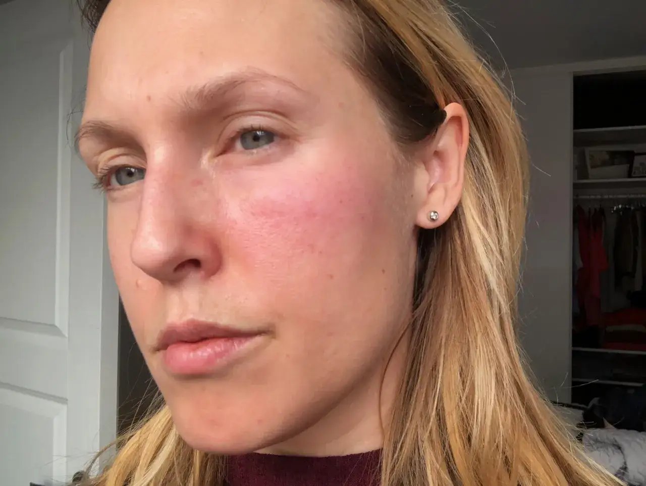 Rodnad och utslag på kinderna tyder på en allergisk reaktion i huden i ansiktet.