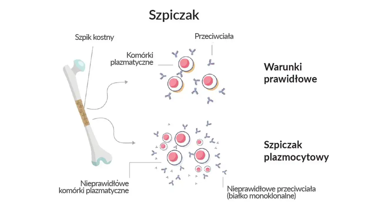 Ilustracja porównuje zdrowe komórki plazmatyczne w szpiku kostnym z nieprawidłowymi komórkami w szpiczaku plazmocytowym, co może pomóc w rozwoju najnowszego leku na szpiczaka mnogiego.