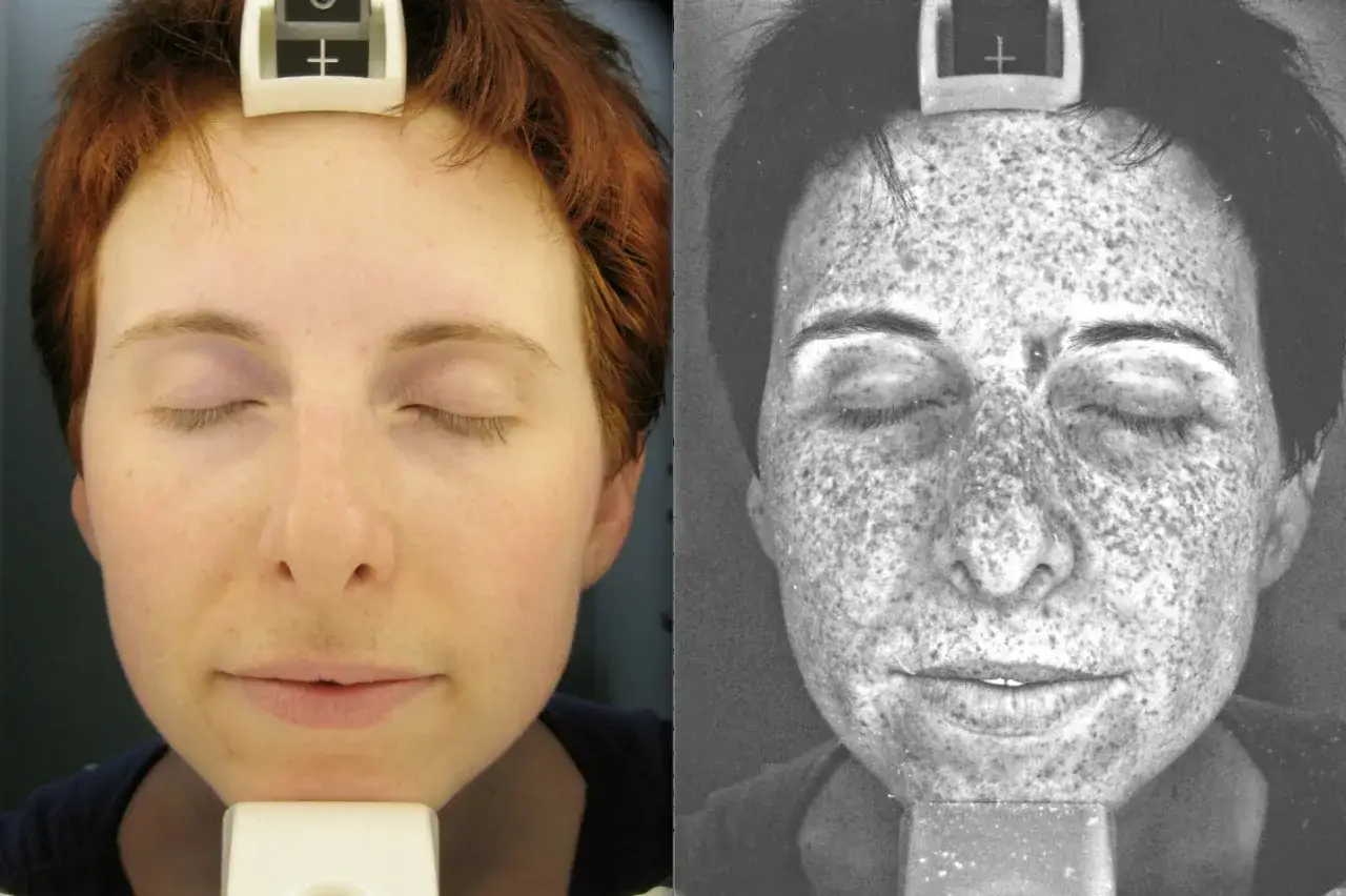 Twarz kobiety w świetle widzialnym i UV. Po prawej widoczne liczne przebarwienia, objawy fotodermatozy.
