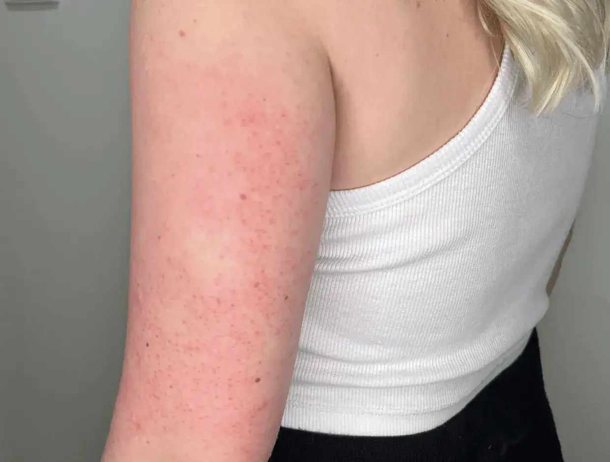 Braccio con cheratosi pilare, una condizione cutanea comune. Scopri come curarla per una pelle più liscia.