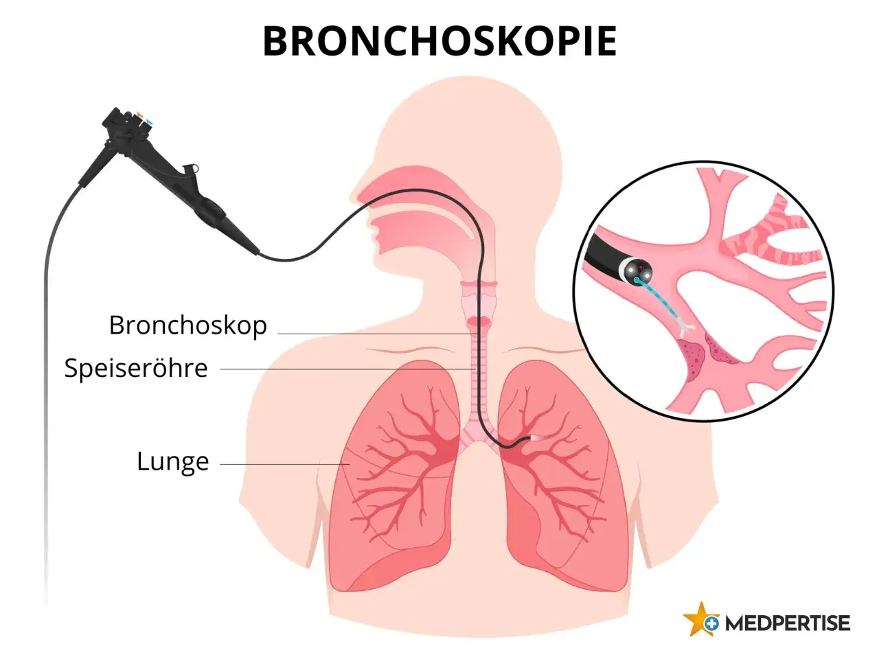 Bronchoskopie: Ein flexibler Bronchoskop wird in die Lunge eingef&uuml;hrt. Die Darstellung zeigt die Lunge und die Atemwege. Informationen zu lungenspiegelung risiken sind wichtig.