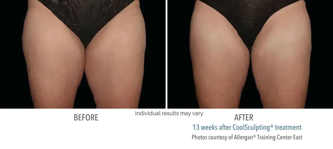 Przed i po kriolipolizie ud. Widoczna redukcja tkanki tłuszczowej i poprawa kształtu ud po zabiegu CoolSculpting.