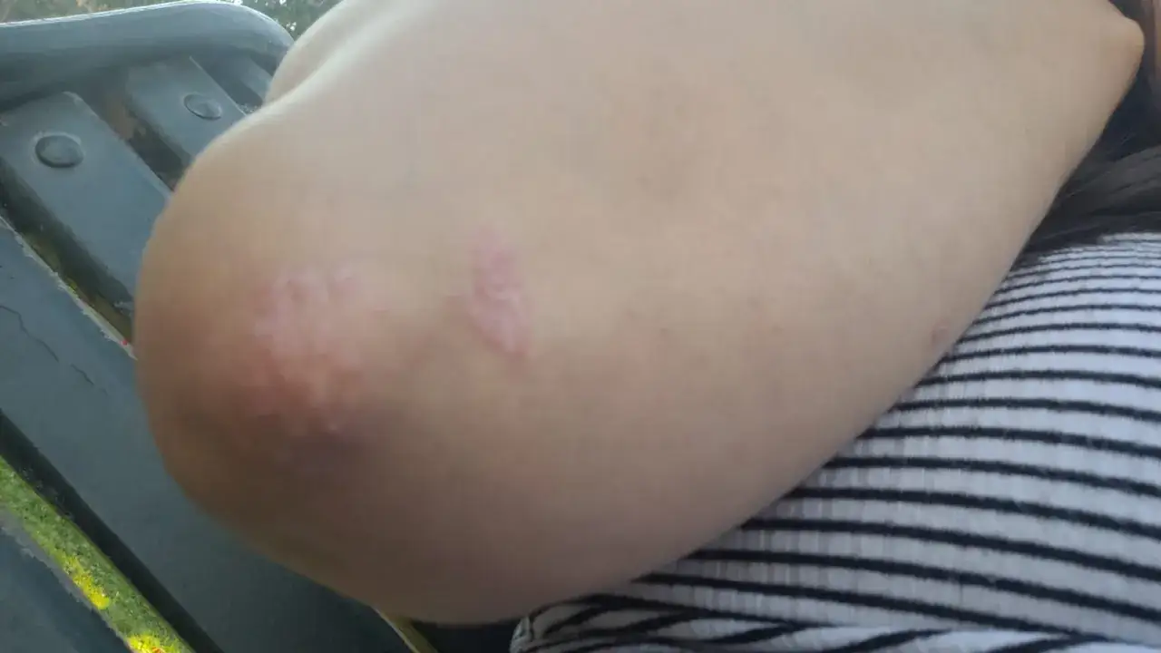 Psoriasis en los codos, con parches escamosos y enrojecidos visibles en la piel.