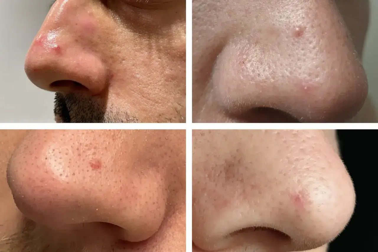 Quatre gros plans du nez montrant des rougeurs et des imperfections, sugg&eacute;rant un diagnostic peau.