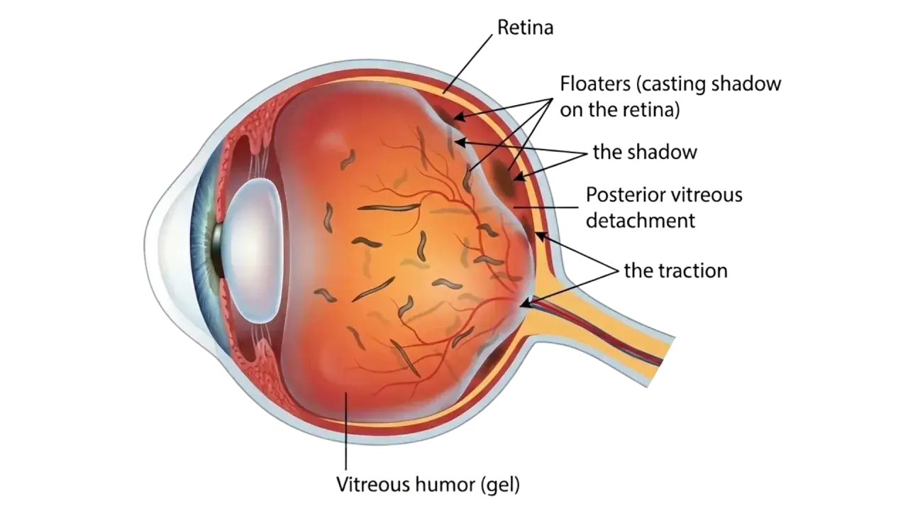 Sezione occhio: corpi mobili nel vitreo causano miodesopsie, proiettando ombre sulla retina. Distacco posteriore del vitreo.