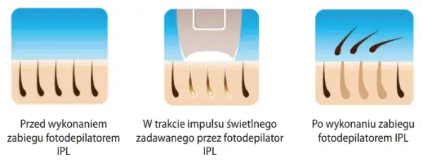 IPL technologia depilacji schemat