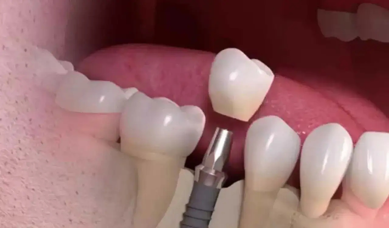 Immagine ravvicinata di un impianto dentale provvisorio in fase di posizionamento su un impianto dentale.