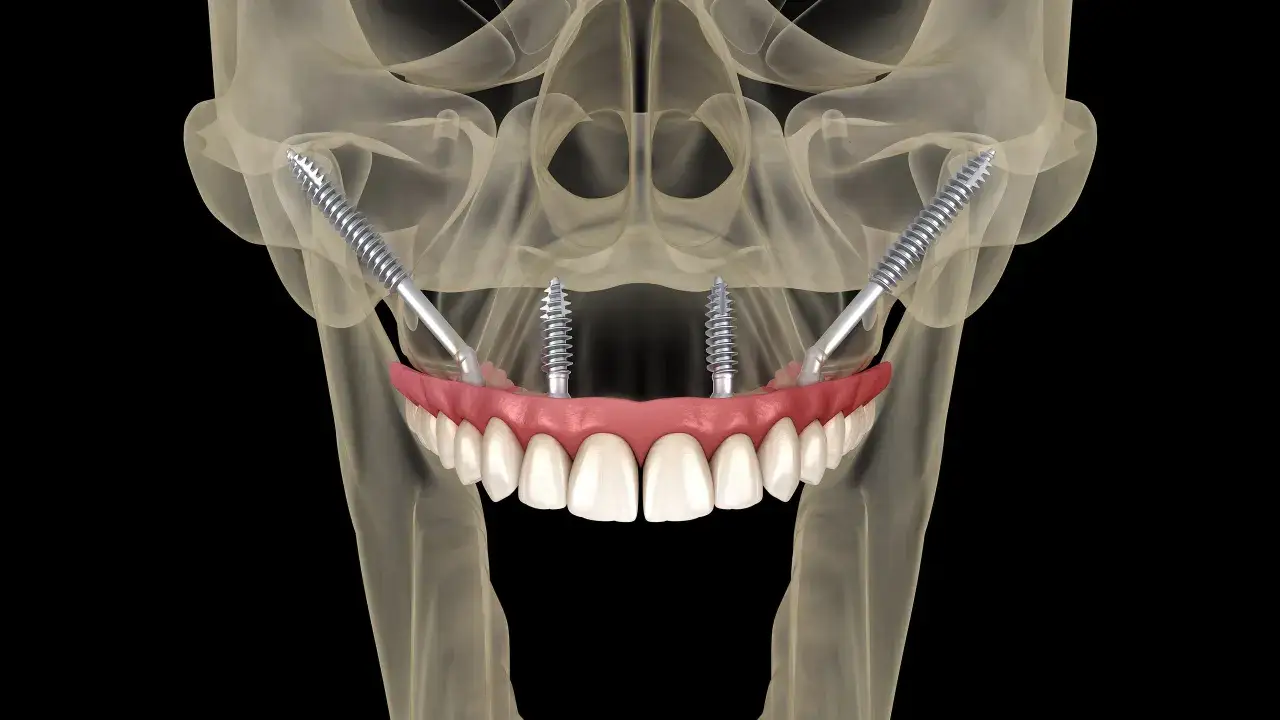 Immagine 3D di impianti zigomatici che fissano una protesi dentale completa.