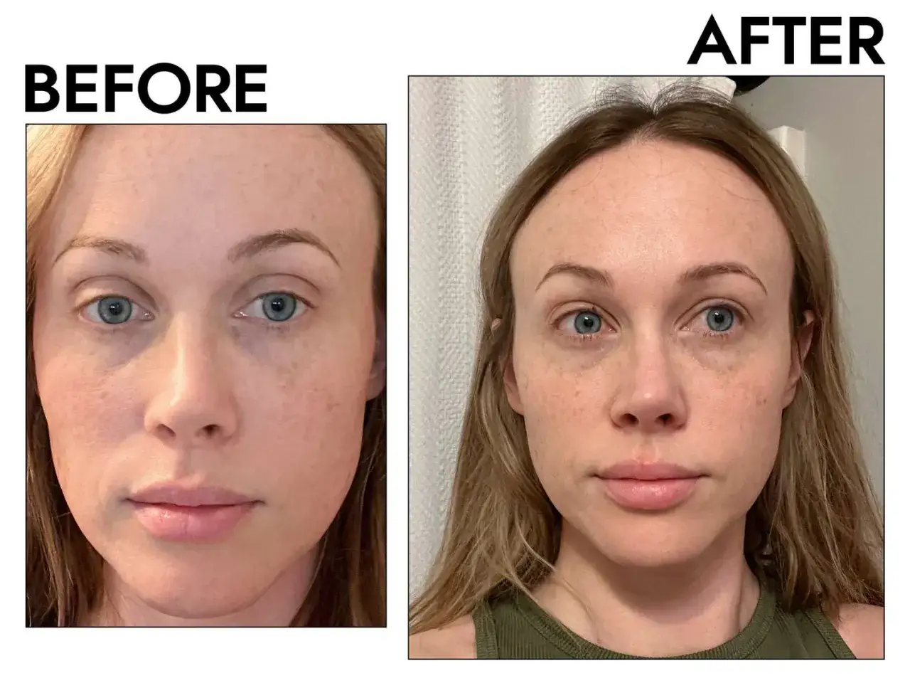 Prima e dopo: il viso di una donna mostra un miglioramento della pelle dopo l'uso di vitamina B3 viso.