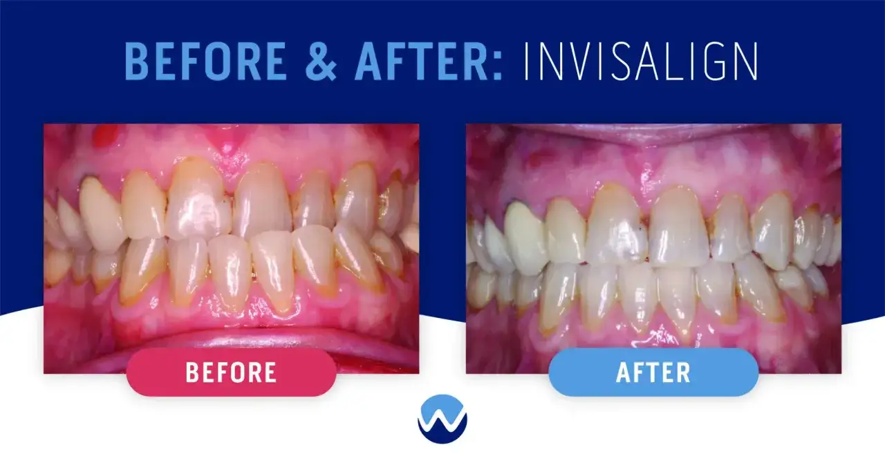 Przed i po: zęby przed i po leczeniu nakładkami Invisalign. Widoczna poprawa uśmiechu.