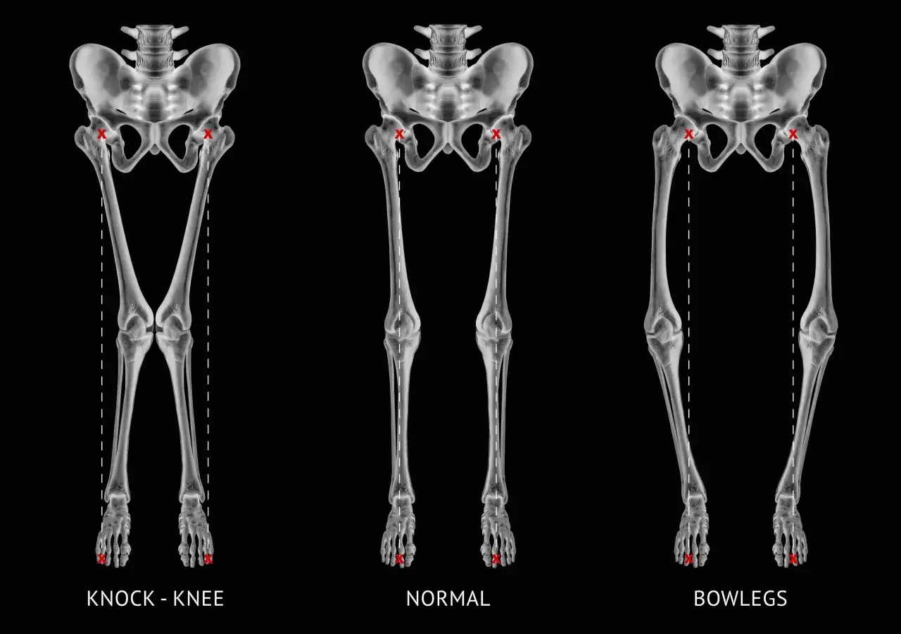 Skelett-Ansichten zeigen X-Beine (Knock-Knee), normale Beine und O-Beine (Bowlegs). Rote Kreuze markieren Hüft- und Fußpositionen.