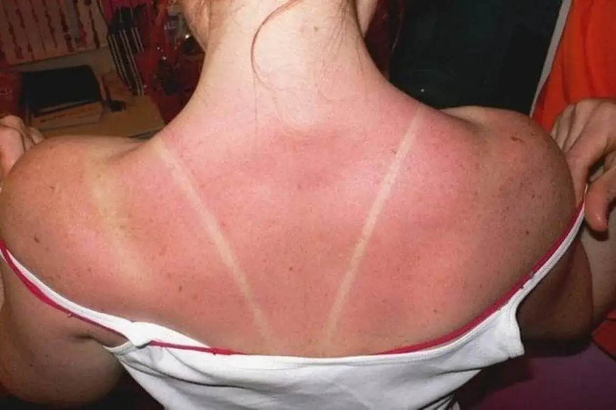 Dos lignes claires sur un dos rouge vif, signe d'un coup de soleil. Pour savoir que mettre sur un coup de soleil, il faut agir vite.