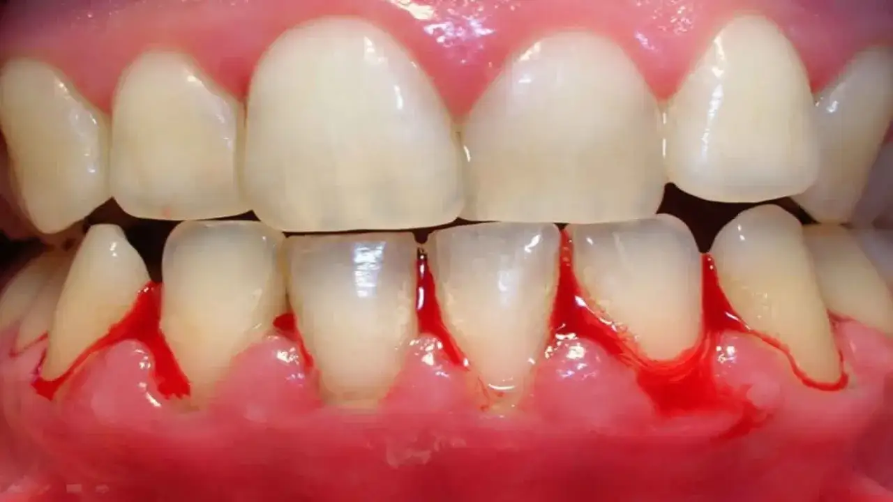 Encías inflamadas y sangrantes, señal de gingivitis grave. Se observa sangrado al tocar la zona.