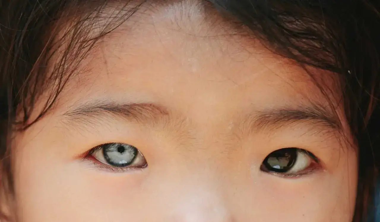 Dziecko z heterochromią częściową. Jedno oko szare, drugie brązowe.
