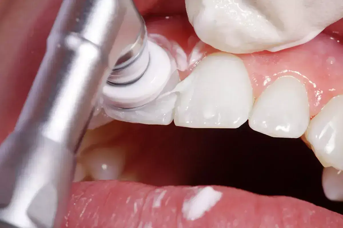 Un dentista pule un diente con una fresa dental. ¡Evita que las caries duelan con buena higiene!