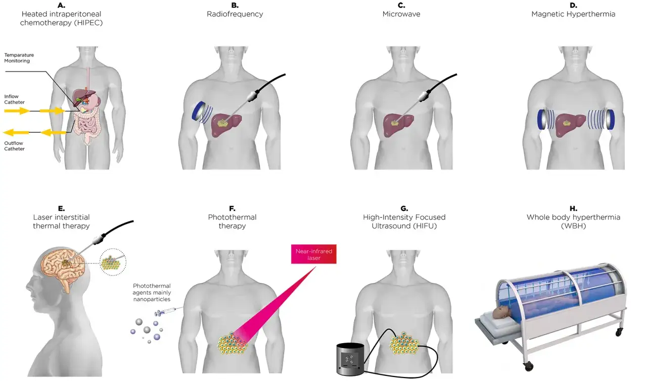 Verschiedene Methoden der Hyperthermie-Therapie: HIPEC, Radiofrequenz, Mikrowellen, Magnetische Hyperthermie, Laser, Photothermie, HIFU und Ganzkörper-Hyperthermie.