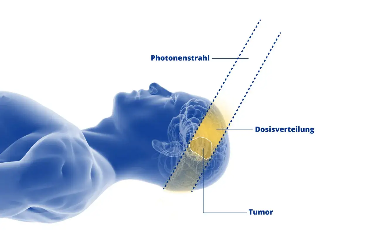 Illustration zeigt die Dosisverteilung eines Photonenstrahls auf einen Tumor im Gehirn, wie bei einer Hirntumor-OP.