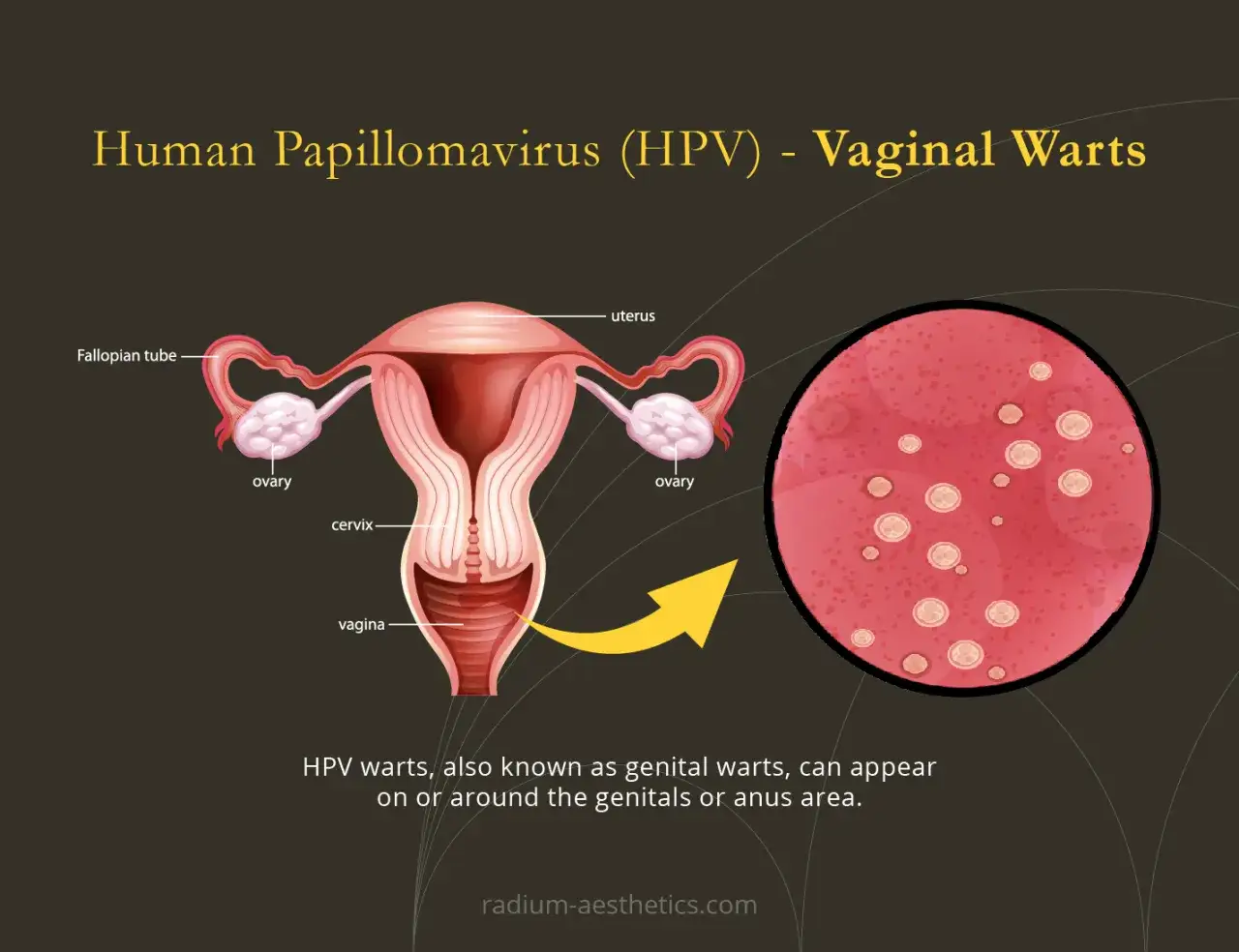 Ilustracja przedstawia narządy rodne kobiety i powiększony obraz brodawek. Wirus HPV może powodować **hpv objawy** w postaci brodawek.