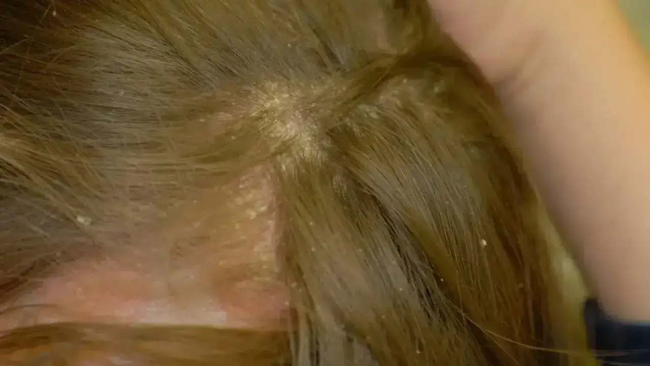 Nahaufnahme einer Kopfhaut mit sichtbaren fettigen Schuppen, die sich zwischen den Haaren absetzen.