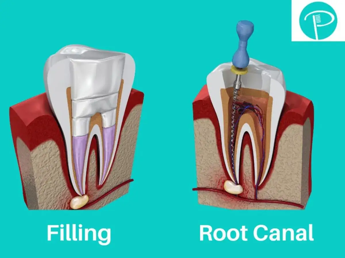 Comparaci&oacute;n de un empaste dental con una endodoncia. La imagen muestra la secci&oacute;n de un diente, ilustrando c&oacute;mo se realiza cada procedimiento.