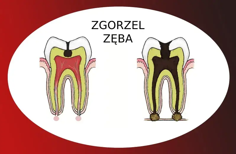objawy powikłań leczenia kanałowego