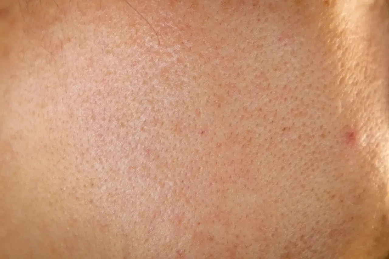 Primo piano della pelle del viso con pori dilatati visibili, texture cutanea con piccole imperfezioni e rossori.