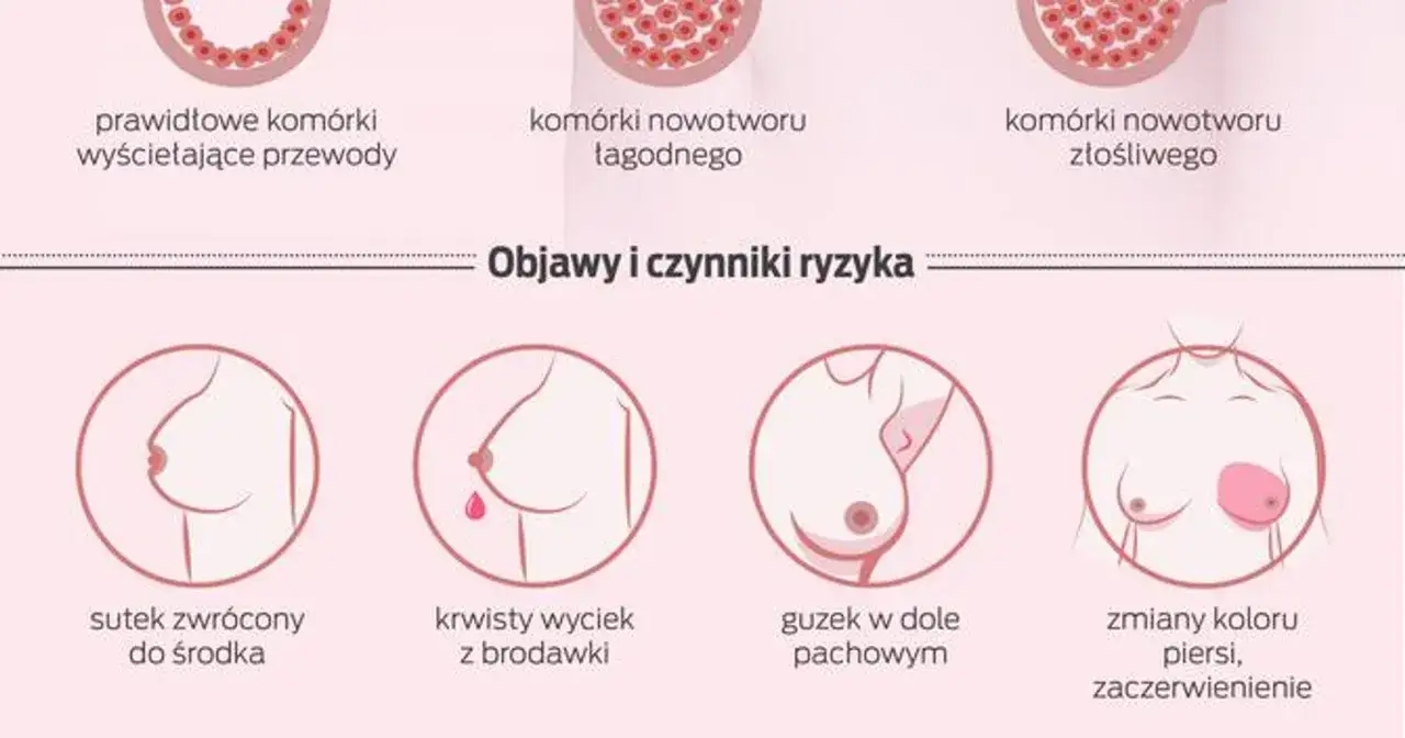 Grafika przedstawia objawy raka piersi: wciągnięty sutek, krwisty wyciek, guzek w dole pachowym i zmiany koloru piersi. Ból piersi może być jednym z sygnałów.
