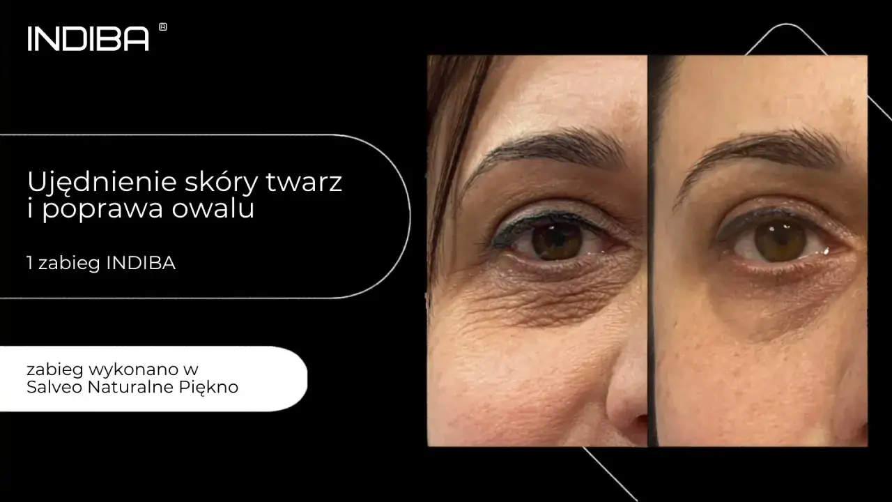 Efekt ujędrnienia skóry twarzy po zabiegu INDIBA. Widoczna poprawa owalu i redukcja zmarszczek.