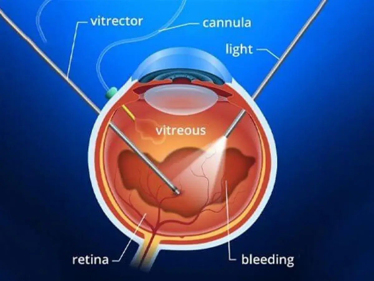 Illustrazione di un occhio con vitrectomia non riuscita: il vitrector e la cannula sono inseriti, ma si verifica un sanguinamento sulla retina.