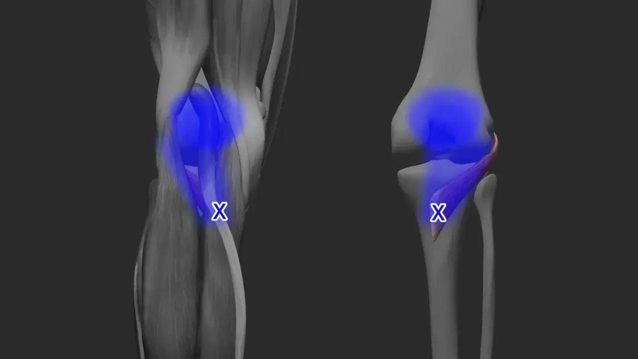 Anatomische Darstellung des Knies mit blauen Bereichen, die auf triggerpunkte knieschmerzen innenseite hinweisen.