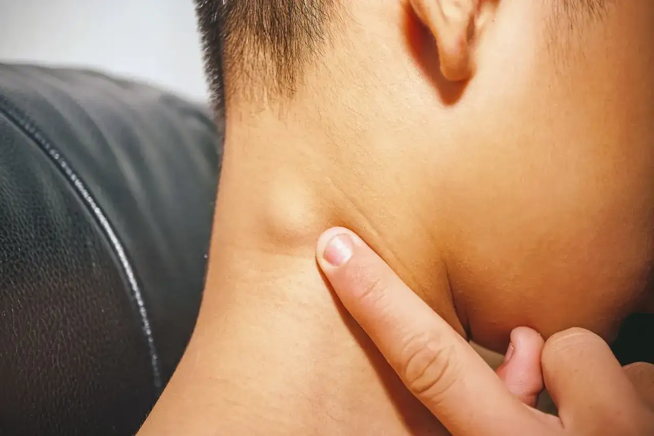 Un doigt touche un ganglion cou douloureux au toucher, une petite bosse visible sous la peau.