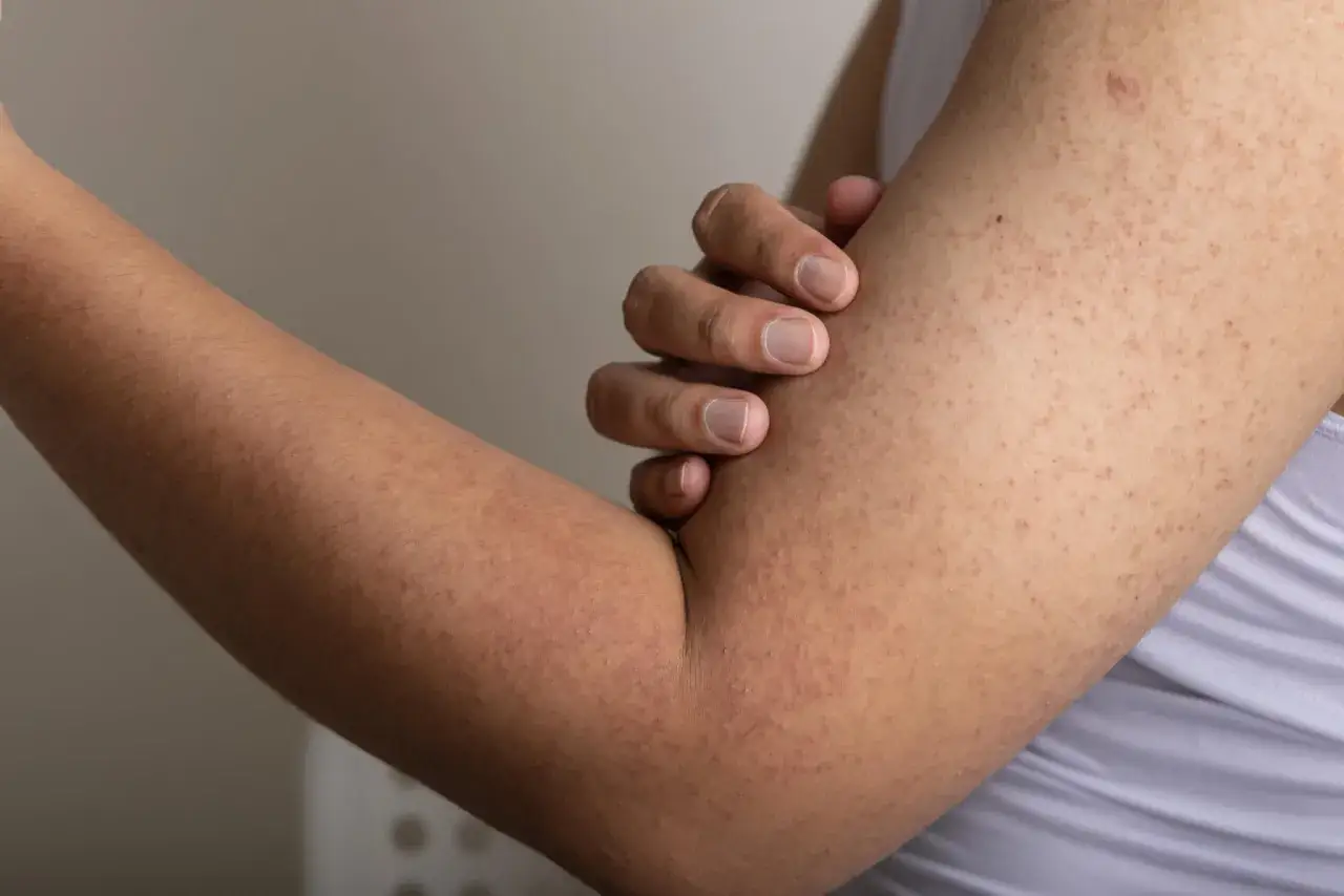 N&auml;ra bild p&aring; en arm med keratosis pilaris. Sm&aring; knottror syns tydligt, vilket kan vara ett tecken p&aring; att en keratosis pilaris behandling beh&ouml;vs.