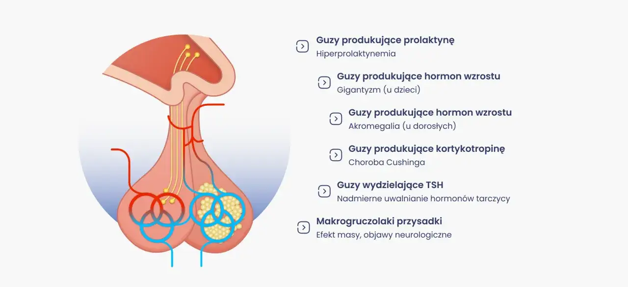 Schemat przysadki mózgowej z zaznaczonymi guzami, w tym nieleczony gruczolak przysadki mózgowej.