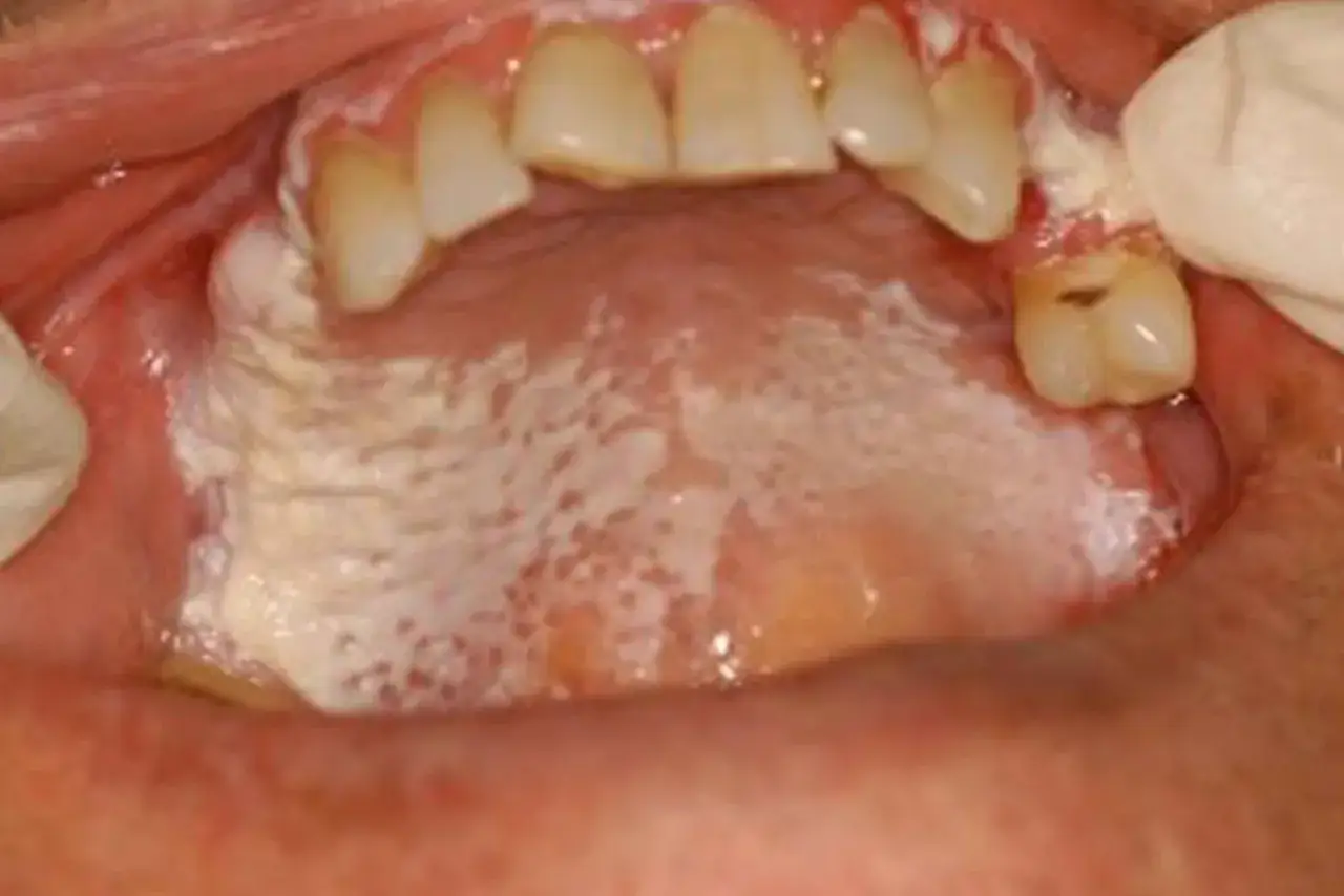 Bocca con lesioni biancastre sul palato e gengive. La leucoplachia si guarisce con cure adeguate.