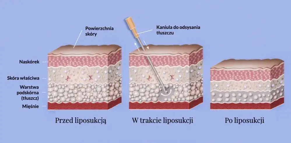 Porównanie metod liposukcji