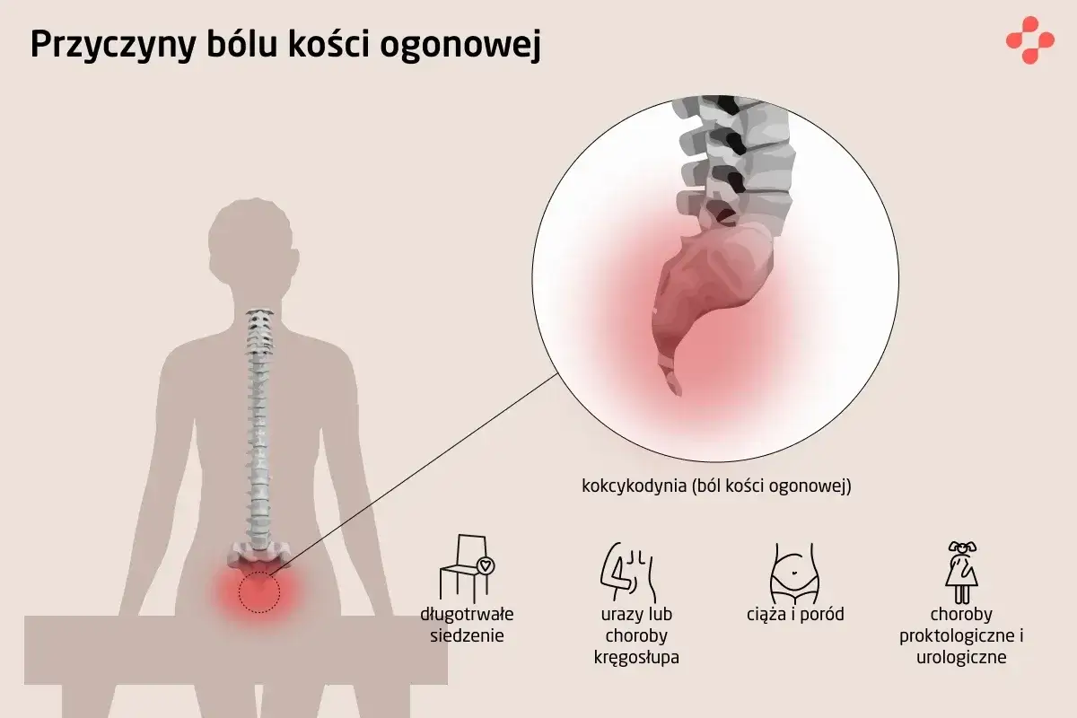 Ilustracja pokazuje ludzki szkielet z zaznaczonym bólem w okolicy kości ogonowej. W powiększeniu widać kość guziczną, która jest przyczyną kokcygodynii.