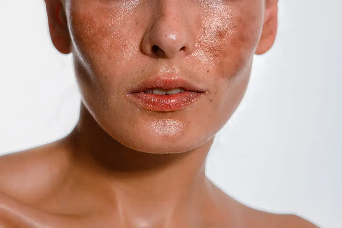 Gros plan sur le visage d'une femme, montrant des taches de lentigo solaire sur ses joues et son nez.