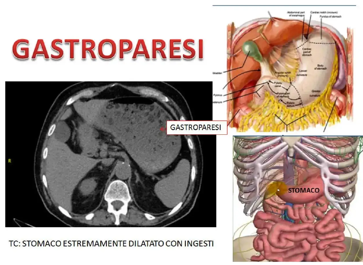TC mostra uno stomaco dilatato, segno di gastroparesi. Anatomia dello stomaco e del sistema digestivo.