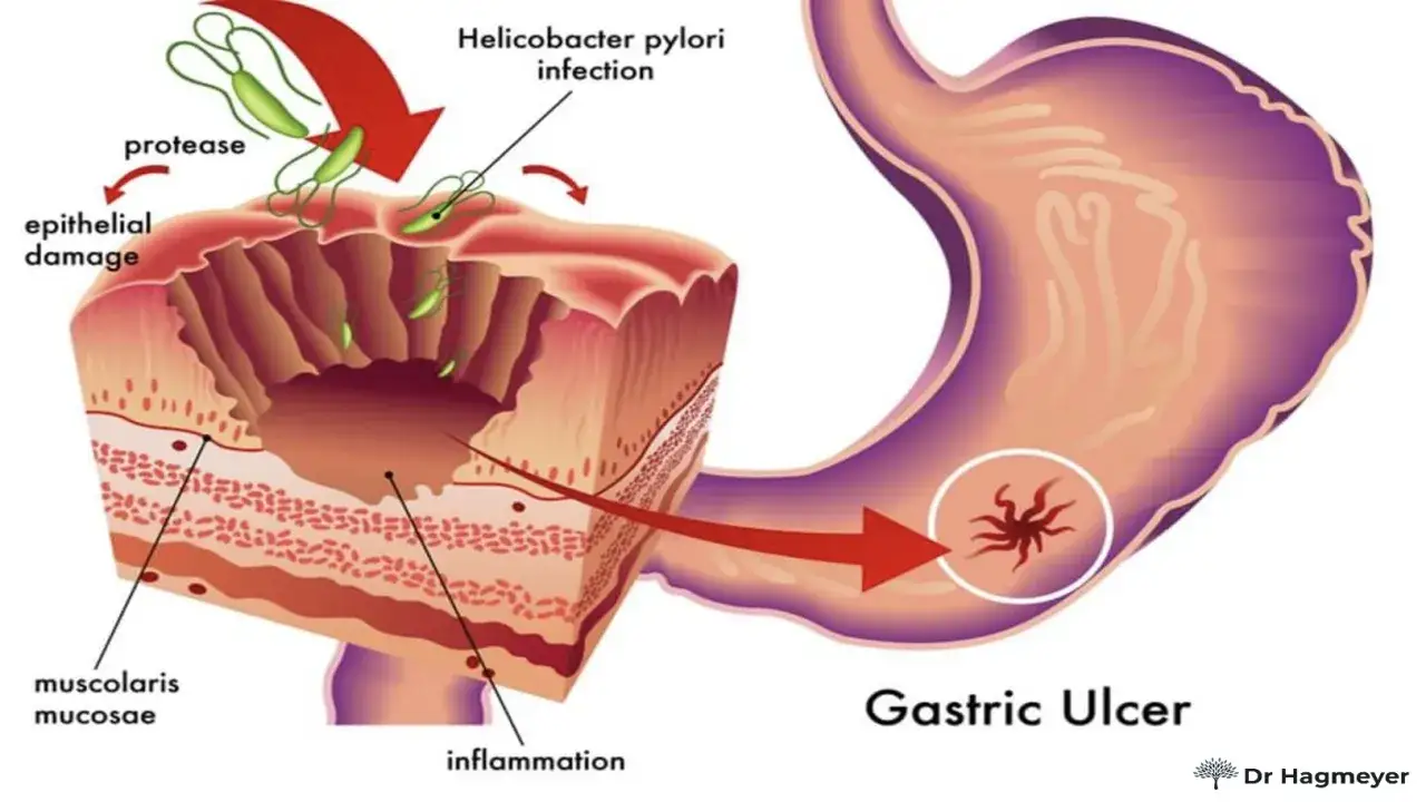 Infezione da Helicobacter pylori causa danno epiteliale e infiammazione, portando a ulcere gastriche. I sintomi possono includere dolore.