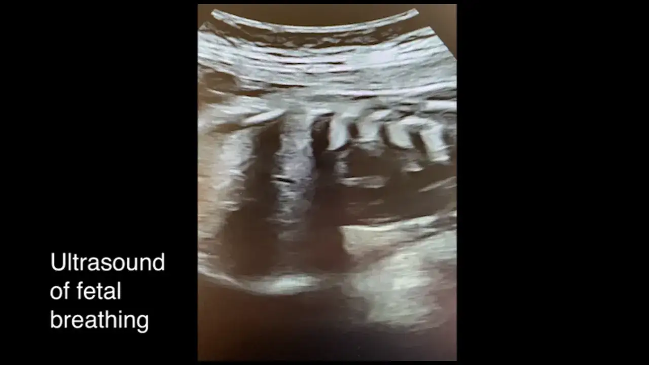 Ecografía de un bebé en embarazo, mostrando movimientos que podrían ser hipo fetal.