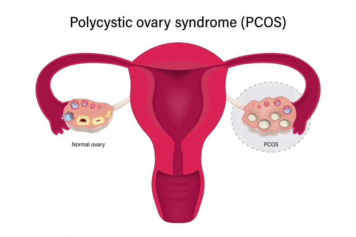 Ilustracja porównuje normalny jajnik z jajnikiem w zespole policystycznych jajników (PCOS), gdzie widoczne są liczne torbiele.