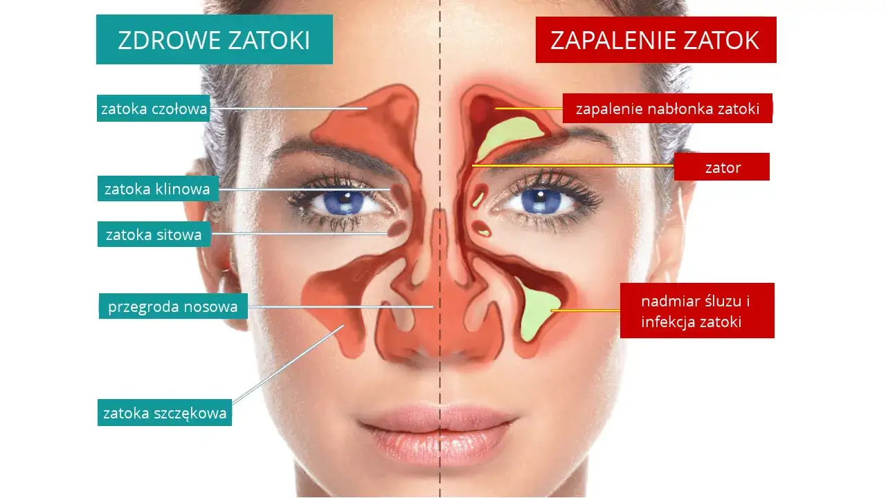 Zapalenie zatok lokalizacja b&oacute;lu