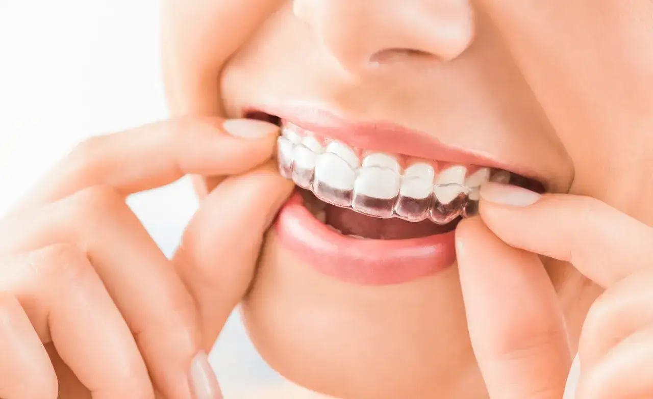 Una persona se coloca un alineador transparente. ¿Cuánto cuesta el invisible line para una sonrisa perfecta?