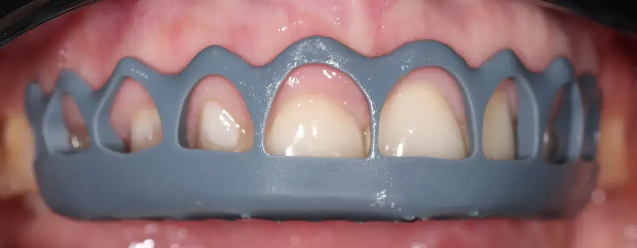 Przygotowanie do zabiegu gingiwektomii. Widoczne zęby i dziąsła, zabezpieczone specjalną osłoną.
