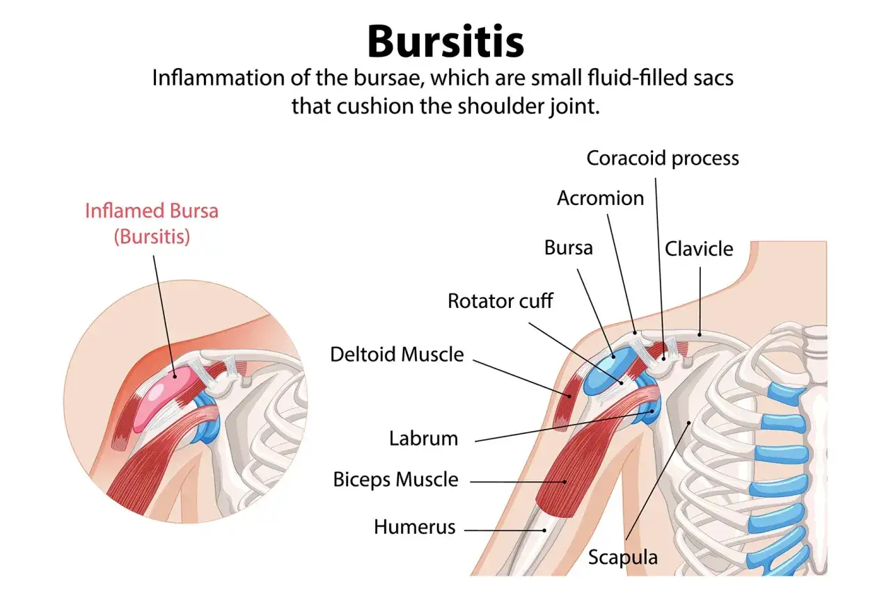Illustration zeigt eine entzündete Schleimbeutel Schulter. Anatomische Details wie Rotatorenmanschette, Bizeps und Knochen sind beschriftet.