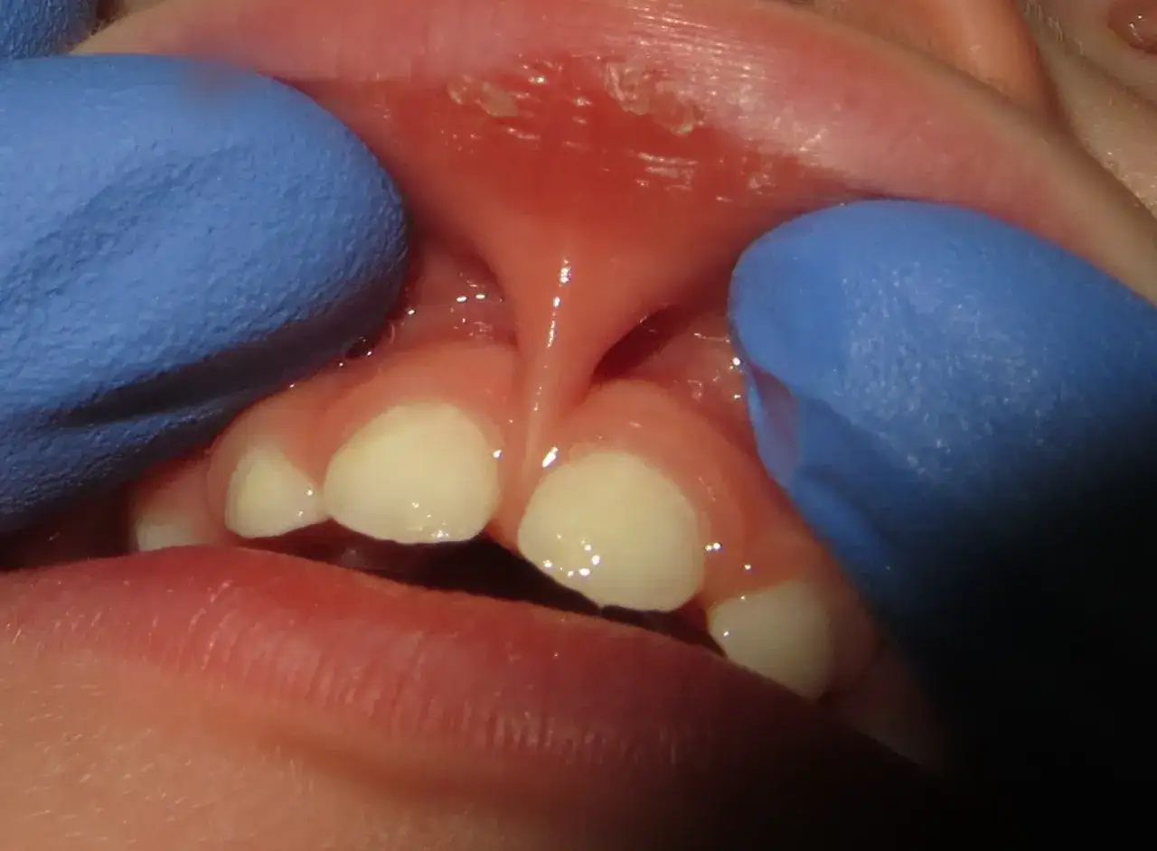 Close-up of a baby's mouth showing a significant lip tie. The frenulum is pulled taut, potentially affecting pacifier use and feeding.