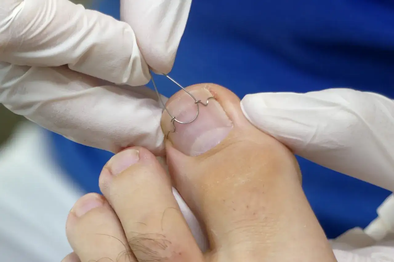 Application d'une orthonyxie sur un ongle incarn&eacute;. Des mains gant&eacute;es ajustent un fil m&eacute;tallique pour corriger la courbure de l'ongle.