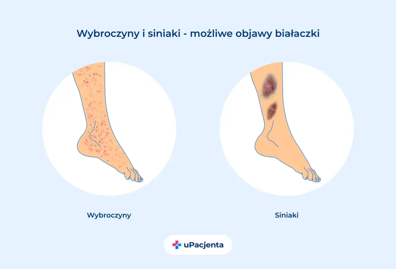 Wybroczyny i siniaki na nogach mogą być objawami białaczki. Ilustracja pokazuje zmiany skórne.